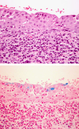 A) Mucosa del glande. En el epitelio superficial se observan algunas células con citoplasma claro y de aspecto granulado. Infiltrado inflamatorio en la dermis superficial con abundancia de células plasmáticas (hematoxilina-eosina, x 64). B) Mucosa del glande. Células que contienen mucina en la porción más superficial del epitelio (azul alcián pH 2,5, x 64).