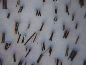 Imagen fotográfica del cuero cabelludo occipital obtenida con la lupa Dermlite Pro HR en la que se aprecia cómo los pelos emergen de la superficie cutánea formando grupos, la mayoría de 2–4 pelos por grupo. Estas agrupaciones representan la porción superficial visible de la unidad folicular.