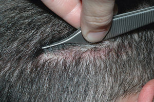 Con el cierre tricofítico los pelos crecen a través de la cicatriz y se consigue que la cicatriz de la zona donante se haga menos detectable.