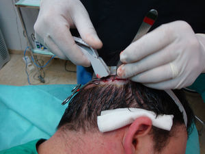 El cierre de la herida de la zona donante se puede realizar con sutura o con grapas como en este paciente, uniendo los bordes de forma muy cuidadosa y precisa.