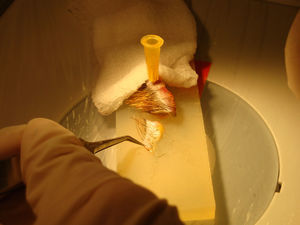 En una primera fase la tira donante se divide en fragmentos transversales más pequeños (slivers) que contienen filas de una o dos unidades foliculares en su espesor.