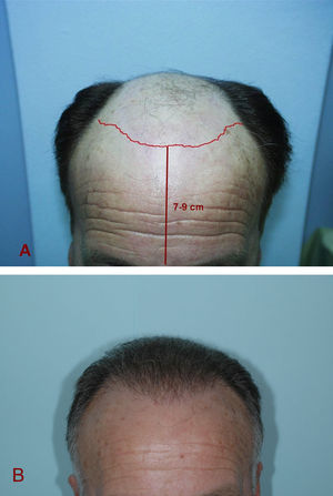 Para crear una línea de implantación natural hay que guardar tres principios básicos: crear una línea de implantación a una distancia determinada de la glabela (7–9cm), respetar las entradas frontotemporales y diseñar un contorno irregular en la línea más anterior. En A se muestra el diseño antes del trasplante y en B el resultado final un año después del trasplante, mostrando la naturalidad de la línea de implantación frontal diseñada.