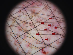 Imagen con lupa de aumento en la que se aprecian los injertos ya insertados en la zona receptora. La retícula mide 1cm2 dividida en 4 cuadrantes. En uno de los cuadrantes se señalan con flechas los injertos implantados (la densidad es de unos 30 injertos por centímetro cuadrado).