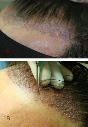 A) Incisiones realizadas en la zona de implantación frontal antes de la inserción de las unidades foliculares. B) Colocación de las unidades foliculares con pinzas de punta muy fina, especiales para trasplante.