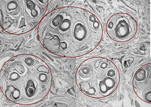 Corte histológico transversal realizado a nivel de la dermis media del cuero cabelludo, mostrando la disposición de los folículos pilosos en unidades foliculares (delimitadas por círculos rojos). Cada unidad folicular está compuesta por folículos terminales, vellosos, glándulas sebáceas y músculos erectores.