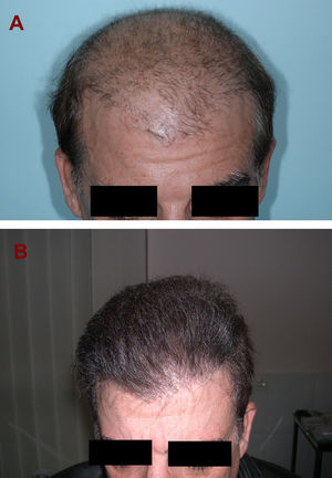 La alopecia androgenética es la principal indicación del trasplante tanto en varones como en mujeres. A) A este paciente se le trasplantaron 5.212 unidades foliculares en un total de 4 sesiones a intervalos de 6 meses. B) El resultado final es de pelo denso y completamente natural.