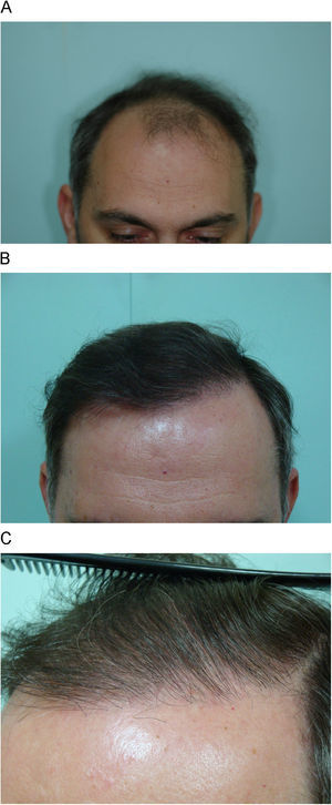 A) Varón con alopecia androgenética antes, y B) después del trasplante con unidades foliculares (2.616 unidades foliculares en total). C) Se aprecia a mayor detalle la línea frontal formada por unidades foliculares de un solo pelo.