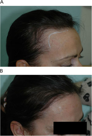 Trasplante en una mujer con alopecia androgenética. A) Recesión de la línea frontotemporal anterior. B) Resultado final al año del trasplante.
