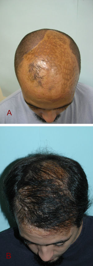 Las quemaduras en el cuero cabelludo son una excelente indicación del trasplante, siempre que el paciente tenga zona donante suficiente. A: Este paciente sufrió una quemadura en el cuero cabelludo a los 18 meses de vida, quedándose con una alopecia cicatricial permanente. B: A pesar de la extensión de la alopecia cicatricial, muestra un cambio estético radical y muy favorable tras tres sesiones de trasplante de aproximadamente 1.500 unidades foliculares por sesión.