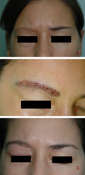 A) Esta paciente presentaba una alopecia de la ceja derecha como consecuencia de radioterapia local por un tumor ocular. B) Imagen intraoperatoria en la que se trasplantaron 232 unidades foliculares, 74 de ellas de dos pelos y 158 de un solo pelo. C) Resultado final a los 9 meses del trasplante.