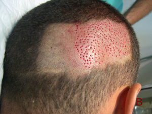 La extracción de unidades foliculares es otro método que consiste en extraer de forma individual las unidades foliculares utilizando un sacabocados circular de 0,8–1mm de diámetro. La figura muestra la zona donante tras la extracción de unidades foliculares. Estos orificios curan rápidamente por segunda intención.