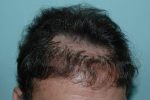 Paciente que había sido trasplantado a los 20 años con injertos en sacabocados de 4mm en la región frontal. Con el paso del tiempo, a medida que el pelo no trasplantado sufre la involución propia de la alopecia androgenética, los injertos de pelo han quedado fuera de lugar. Este ejemplo ilustra la permanencia del pelo trasplantado y los problemas que pueden surgir al trasplantar a pacientes jóvenes con alopecias incipientes.