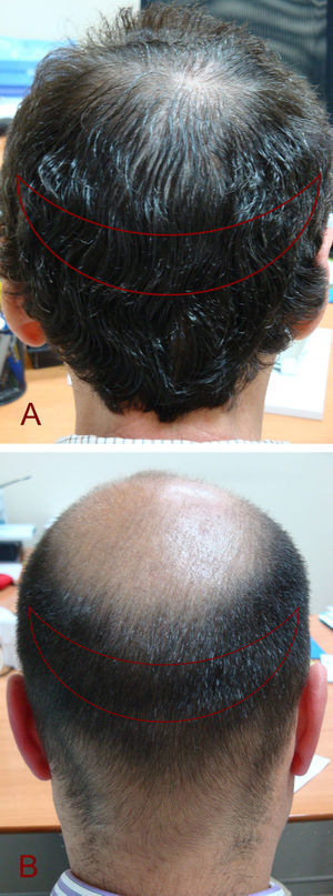 La zona donante debe evaluarse de forma individualizada. Puede ser: A) amplia y densa, o B) estrecha, en cuyo caso hay que tener en cuenta que el pelo también puede perderse cuando la calvicie de la nuca vaya ascendiendo.
