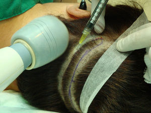 Infiltración de anestesia en la zona donante. En esta figura se muestra la aplicación de un aparato para dar masaje en la zona adyacente al pinchazo («anestesia vibratoria»).
