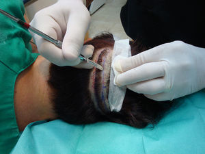 Extirpación de la zona donante. La incisión de los bordes debe ser paralela a los folículos pilosos y a una profundidad máxima de 5–7mm.