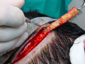 Despegamiento de la tira de tejido donante del tejido subyacente.