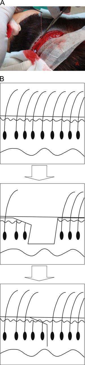 Cierre tricofítico. A) Se aprecia la extirpación de un pequeño fragmento (1mm) del borde inferior de la herida quirúrgica con una tijera de punta fina. B) El objetivo de este procedimiento es que los folículos pilosos emerjan a través de la cicatriz.