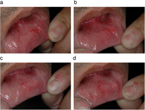 Caso 1. Placa circinada eritematosa de borde blanquecino sobreelevado localizada en la mucosa del labio inferior. Se observa cómo las lesiones van migrando en 4 días consecutivos. A) día 1. B) día 2. C) día 3. D) día 4.
