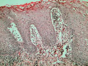 Caso 1. Acantosis con adelgazamiento suprapapilar que se acompaña de un importante edema adventicial con espongiosis. Se observa, además, un infiltrado inflamatorio compuesto casi exclusivamente por neutrófilos, que presentan una marcada exocitosis y en las capas altas de la mucosa se agrupan para formar microabscesos (hematoxilina-eosina, x200).