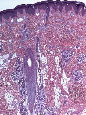 Hallazgos histopatológicos de la biopsia tomada del centro de la lesión. Aumento del número de vasos en la dermis superficial y media y de las glándulas ecrinas. (Hemotoxilina- eosina x 25).