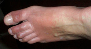 Eccema que afecta a los dedos, al empeine, al tobillo y a la parte inferior de la pierna.