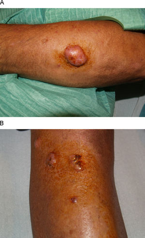 A) Tumoración eritemato violácea de consistencia dura en el antebrazo izquierdo. B) Pápulas y nódulos de superficie ulcerocostrosa en la cara anterior de la pierna izquierda.