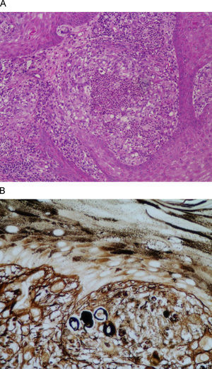 A) Hiperplasia pseudoepiteliomatosa epidérmica; infiltrado inflamatorio granulomatoso con zonas de abscesificación central en la dermis (hematoxilina eosina, ×100). B) Cuerpos redondos con refuerzo periférico (plata metenamina, ×200).