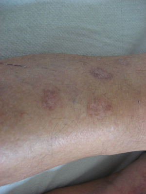 Cicatrices residuales en la zona de lesiones previas tratadas mediante crioterapia.