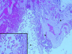 Tumor compuesto por luces vasculares que se disponen en distintos patrones: a) luces independientes separadas por un estroma de colágeno. b) espacios vasculares individualizados pero dispuestos pared con pared, de forma que no se apreciaba apenas estroma entre ellos. c) grandes luces vasculares en las que parecían flotar islas constituidas por un centro de colágeno y tapizadas por células endoteliales. (Hematoxilina eosina, ×40; detalle, hematoxilina eosina, ×200).