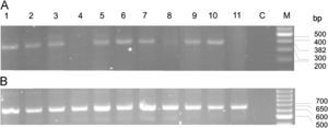 A) ABCB5 RT-PCR amplification of ten acral melanoma primary tumors (lanes 1–10); normal skin (lane 11); C, negative control and M, 100bp ladder molecular marker. B) RT-PCR amplification of beta actin from the same samples as in A.