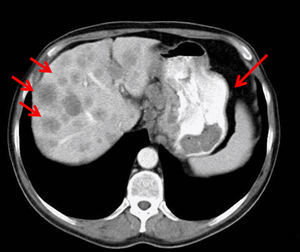 Imagen de la tomografía axial computarizada. Presencia de áreas de hipercaptación compatibles con cáncer gástrico con metástasis hepáticas (flechas rojas).