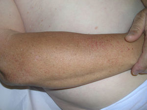 Múltiples telangiectasias en la cara externa del antebrazo derecho.