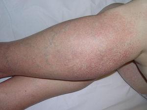 Telangiectasias que afectan a ambas piernas y a la cara posterior de los muslos.