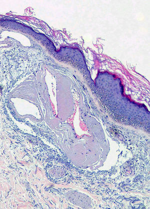 Vasos dilatados con distribución y contornos irregulares en la dermis superficial (hematoxilina-eosina, ×40)