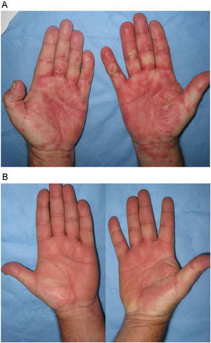 Eritema y edema intenso en las palmas, previamente no afectadas, en el paciente n.° 1, a pesar de solapar la retirada de efalizumab con ciclosporina durante 4 semanas (A). Control de las lesiones tras la segunda infusión de infliximab (B).
