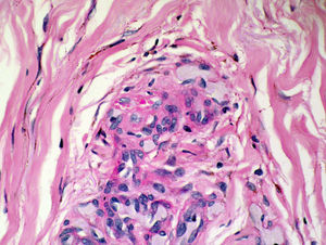 Biopsia de las lesiones del miembro inferior derecho (hematoxilina-eosina ×400). Se observan hematíes entre las células fusiformes y focalmente en su interior glóbulos hialinos PAS positivos.