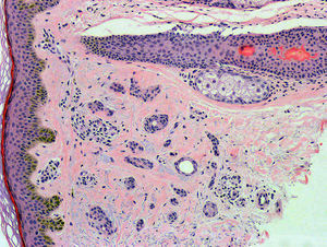 Tumoración benigna en la dermis papilar formada por cordones y conductos de células epitelioides, embebidas en un estroma esclerótico (hematoxilina-eosina x100).