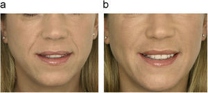 Paciente tratada con relleno de ácido hialurónico en los surcos nasogenianos antes (a) y después (b) del tratamiento (foto cedida por Q-Med, España, S.L.).