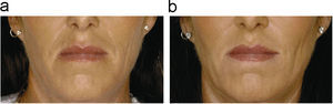Paciente tratada con ácido hialurónico en la región perioral antes (a) y después (b) del tratamiento (foto cedida por Q-Med, España, S.L.).