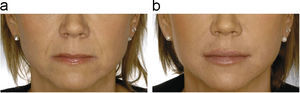 Paciente tratada con ácido hialurónico en los labios antes (a) y después (b) del tratamiento (foto cedida por Q-Med, España, S.L.).