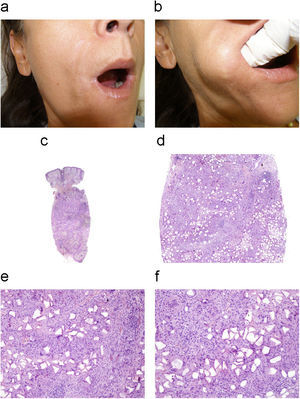 Paciente con reacción inflamatoria intensa secundaria a material de relleno permanente (a,b). La imagen histológica de hematoxilina-eosina revela una reacción granulomatosa con células gigantes de tipo cuerpo extraño en el tejido celular subcutáneo (H/E, 1,25×, 10×) (c,d). Se evidencia material de aspecto poligonal, compatible con depósito de Dermalive® (H/E, 20×, 40×) (e,f).