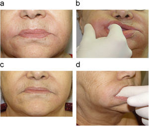 Paciente con una reacción inflamatoria intensa pocos meses después de tratarse con material de relleno permanente. A pesar de tomar corticoides orales durante 3 años no experimentó mejoría (a,b). Tras sólo un mes después de iniciar tratamiento con alopurinol por vía oral se objetivó una respuesta muy satisfactoria (c,d).