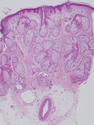 Hiperplasia sebácea que ocupa toda la dermis (hematoxilina-eosina x 200).