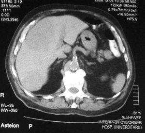 Tomografía axial computarizada abdominal con metástasis hepáticas.
