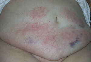 Lesiones de aspecto eccematoso periumbilicales en las zonas de administración de enoxaparina subcutánea.
