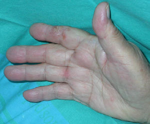Lesiones dishidrosiformes en la palma de la mano derecha.