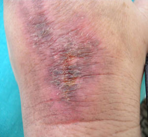 Lesión eritematosa con erosiones superficiales en el dorso de la mano izquierda.