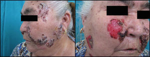 Clínica típica de pénfigo vulgar, con lesiones eritemato-costrosas en la cara de una paciente.