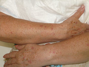 Pápulas eritematosas en el dorso de ambos antebrazos, algunas con erosión central.