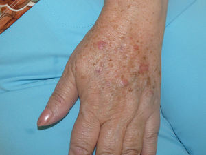 Detalle de las pápulas en el dorso de la mano, sobre una piel con daño actínico.